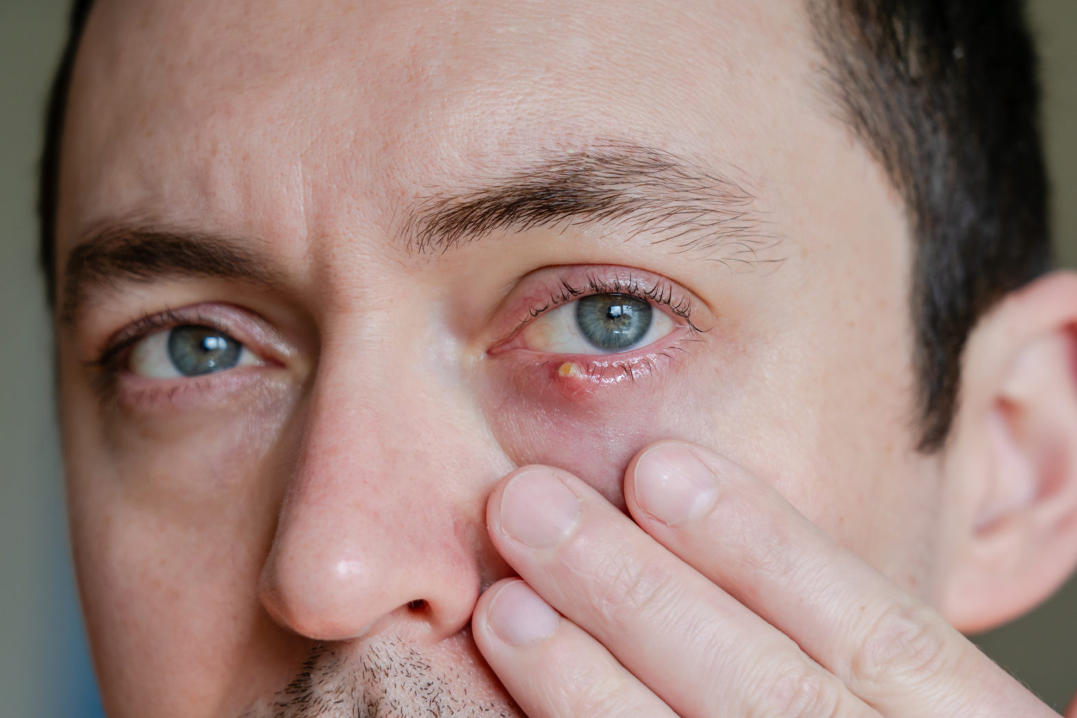 What is Blepharitis?