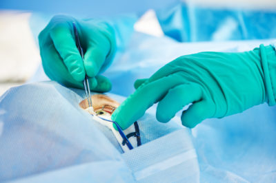 ophthalmology operation. Surgeon's hands in gloves performing la