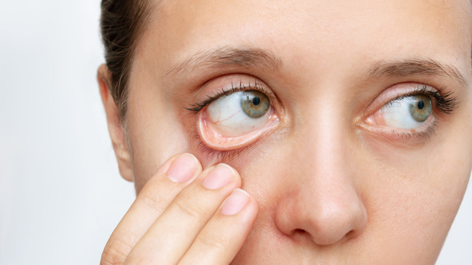 Dry Eye Linked to Increased Risk for Mental Health Disorders: A Deep Dive into the Connection