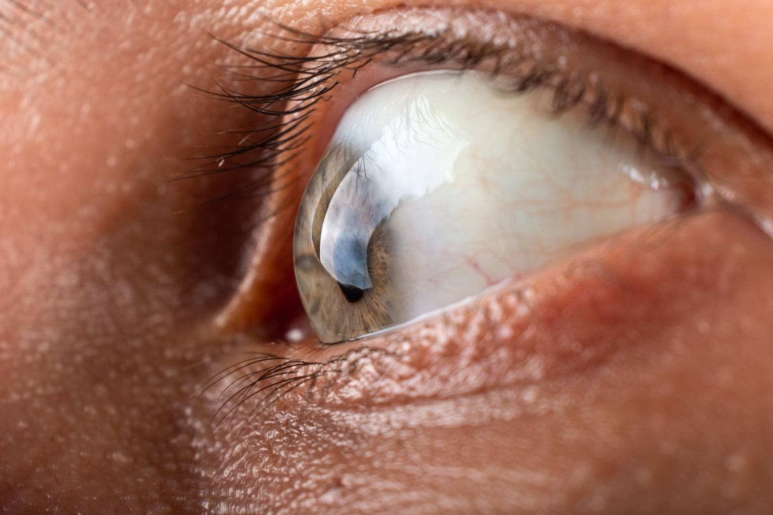 </noscript>Ocular Tuberculosis: Symptoms and Treatment